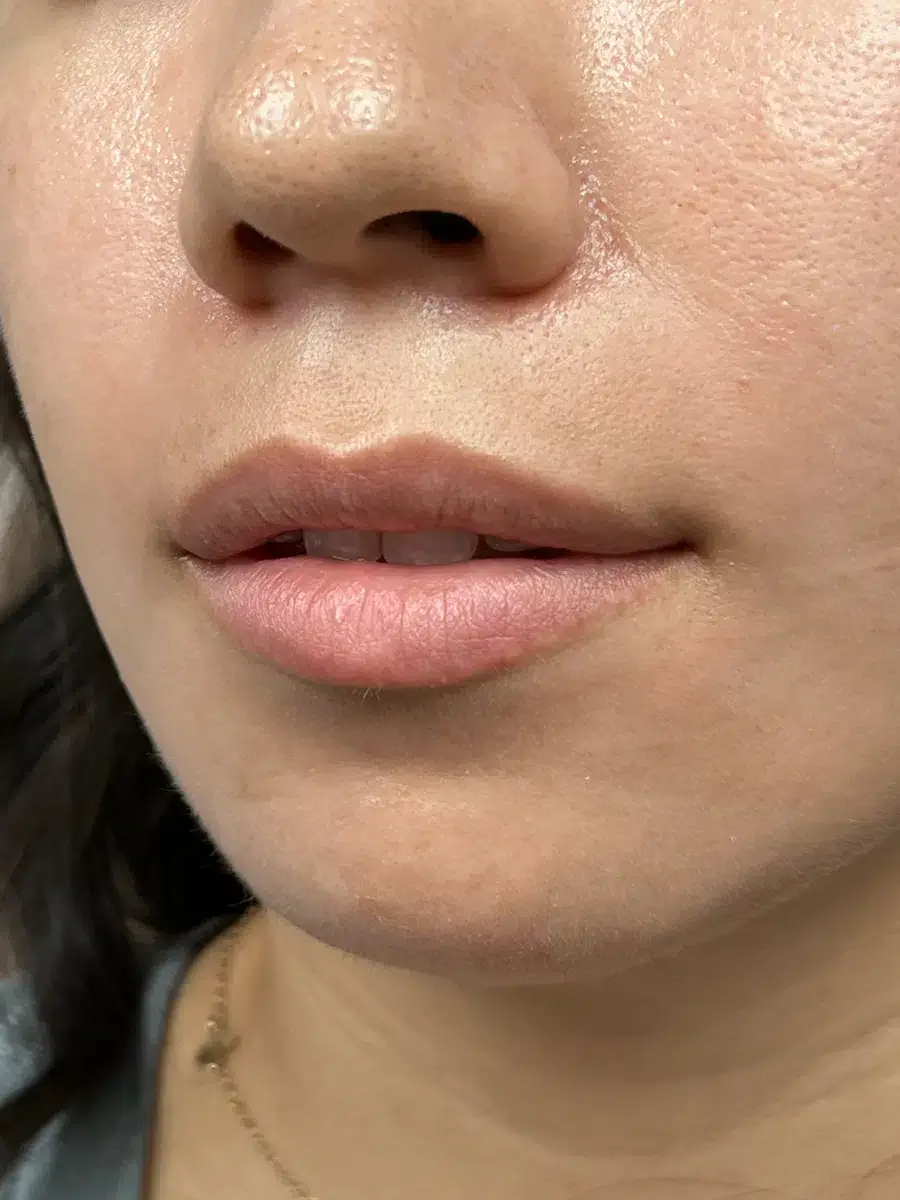 Before Lip Filler Treatment Photo | Auri Aesthetics in Gilbert, AZ