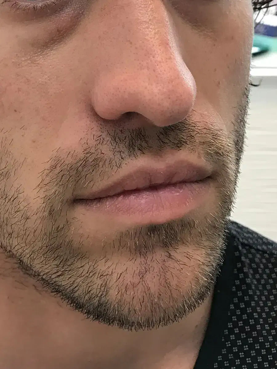 Before Lip Filler Treatment Photo | Auri Aesthetics in Gilbert, AZ