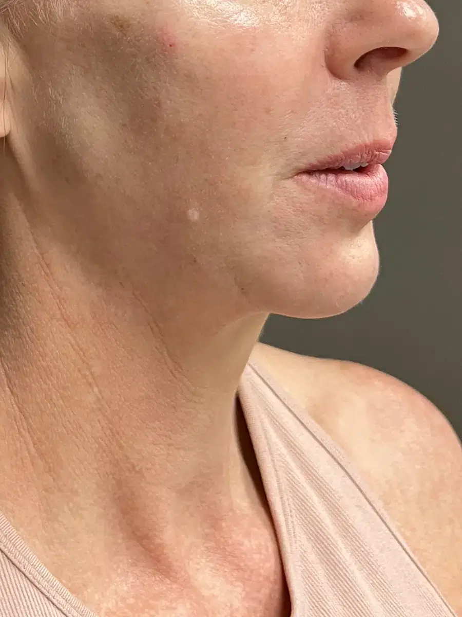 After Chin Augmentation Treatment Photo | Auri Aesthetics in Gilbert, AZ